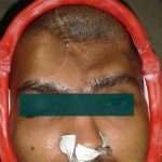 Prostho-cranial-Implant-1-150x150