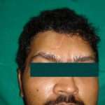 Prostho-cranial-Implant-3-150x150