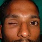 Prostho-eye-1-150x150
